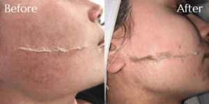 Dermaplaning client results 7