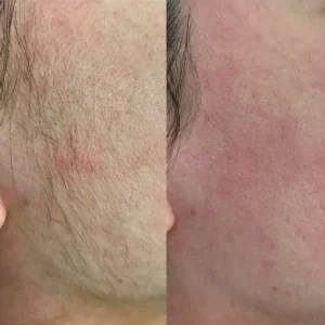 Dermaplaning client results 2