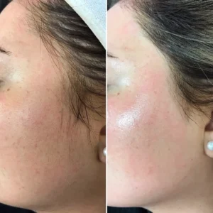 Dermaplaning client results