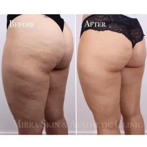 BBL (Brazilian Butt Lift) / Cellulite Treatment clinic in melbourne client results
