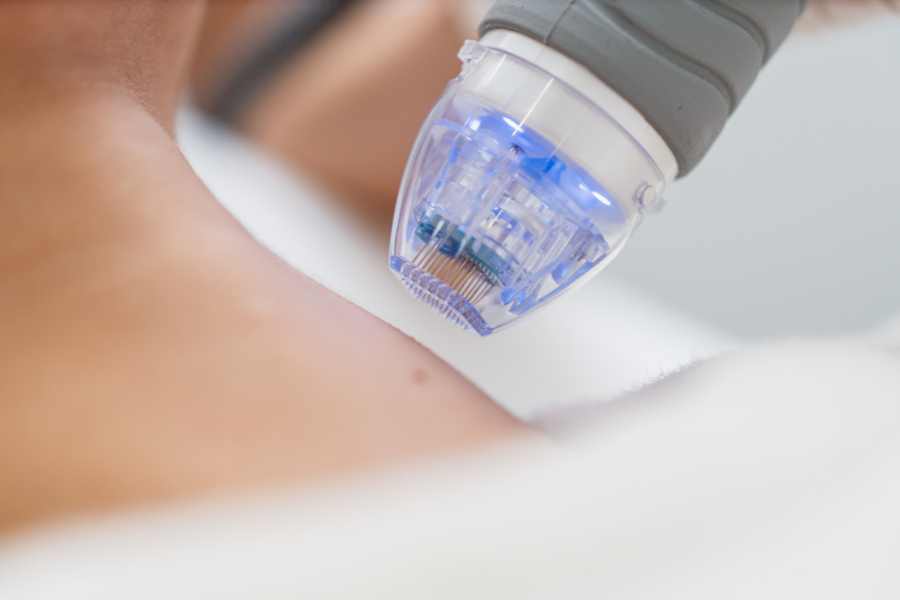 Fractional RF Needling and plasma skin tightening in melbourne