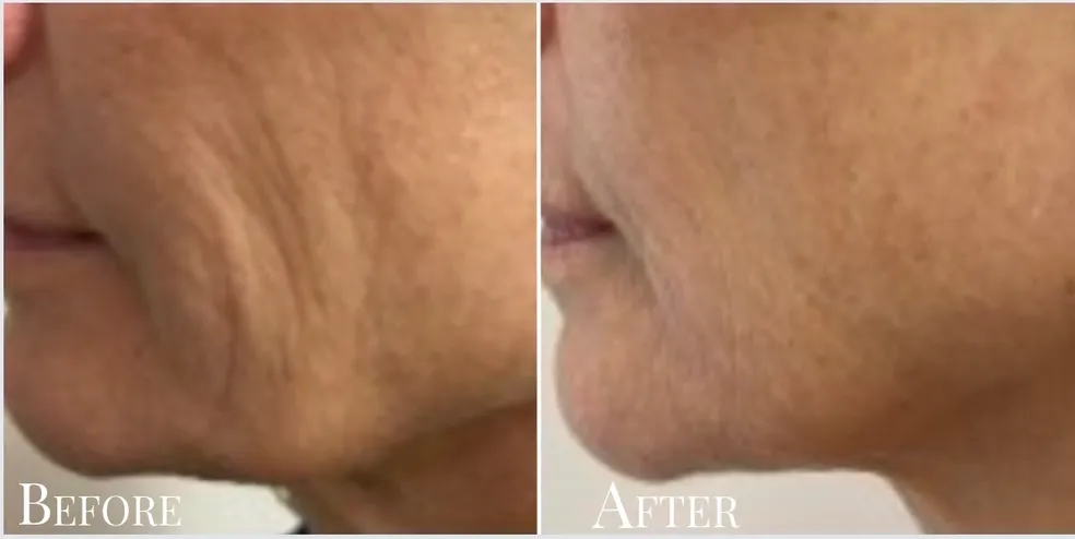 Fractioned RF Needling : Plasma skin tightening client results before and after