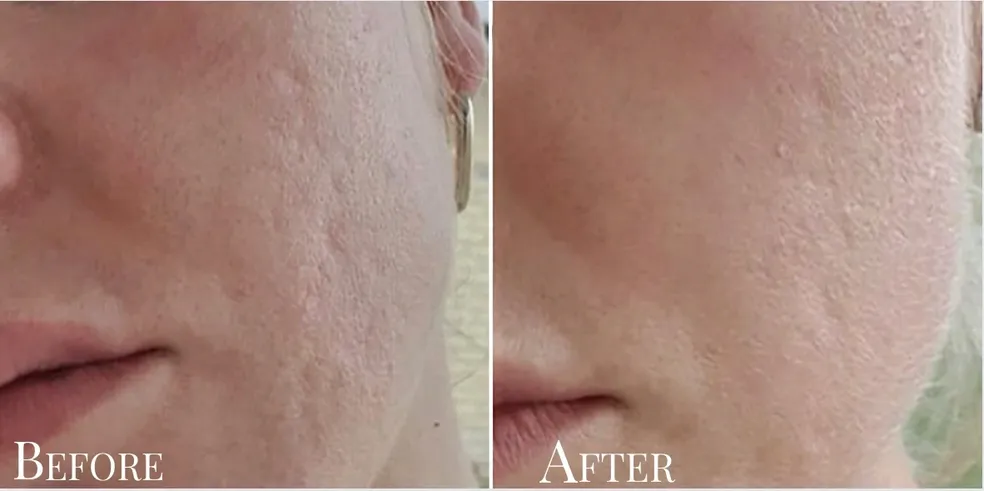 Fractioned RF Needling : Plasma skin tightening client results face