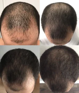 Hair Regrowth Treatment Results