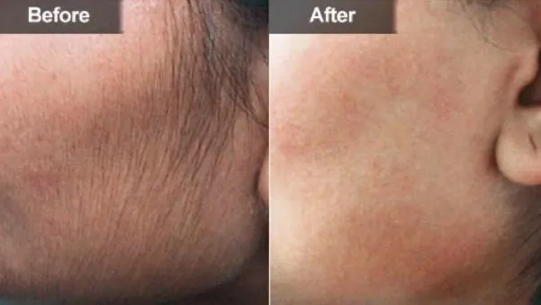 IPL Permanent hair removal treatment client results