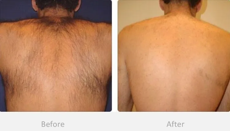 IPL Permanent hair removal treatment client results