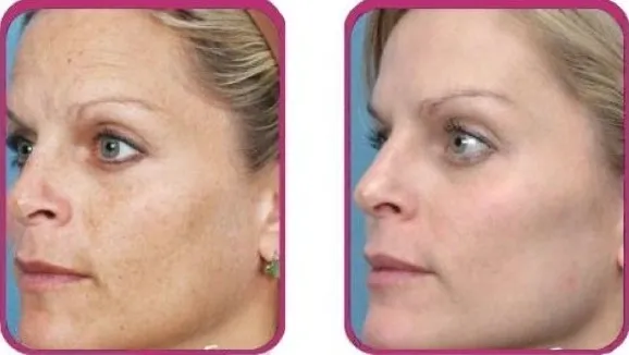 IPL Skin Rejuvenation client success story