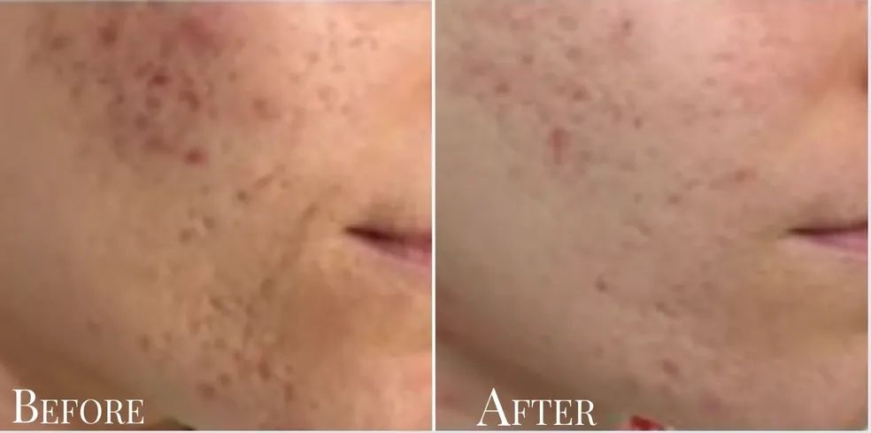Plasma skin tightening client results