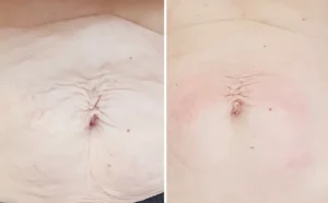 RF Body and skin tightening in melbourne client results