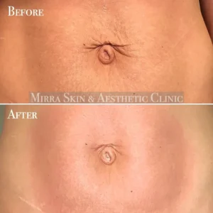 RF Body and skin tightening in melbourne client results