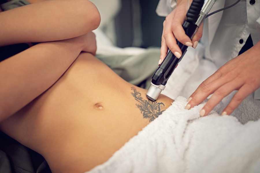 efficient laser tattoo removal in melbourne