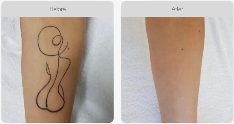 laser tattoo removal in melbourne client results