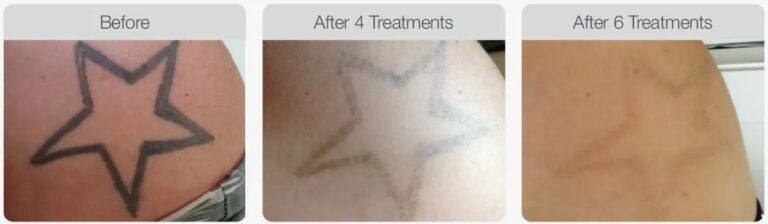 laser tattoo removal in melbourne client results