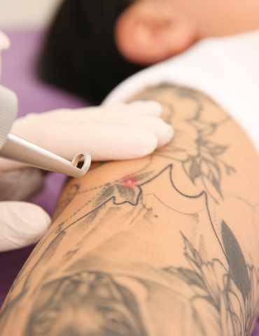 laser tattoo removal in melbourne