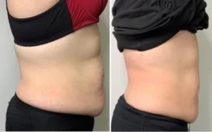 ultrasound fat cavitation and body sculpting client results in melbourne