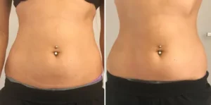 ultrasound fat cavitation and body sculpting client results in melbourne