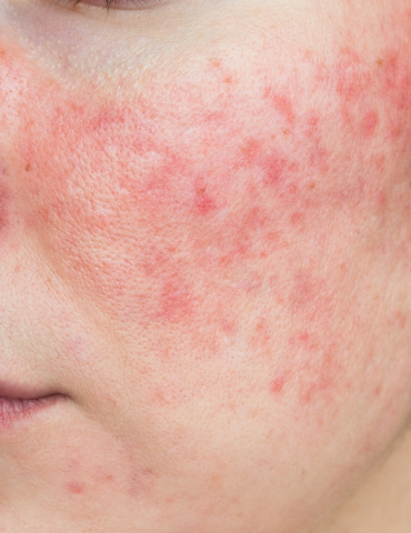 Rosacea Treatment / IPL Redness Therapy in melbourne