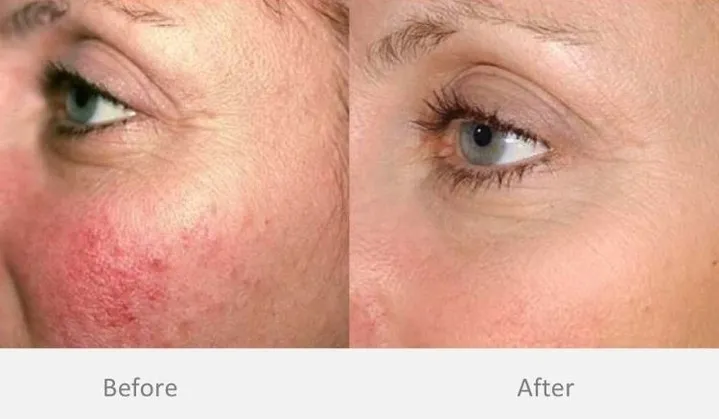 broken capillary removal treatment in melbourne client results
