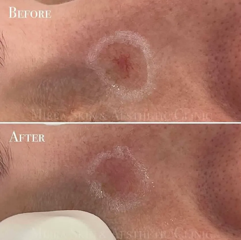client results for broken capillary removal treatment in melbourne