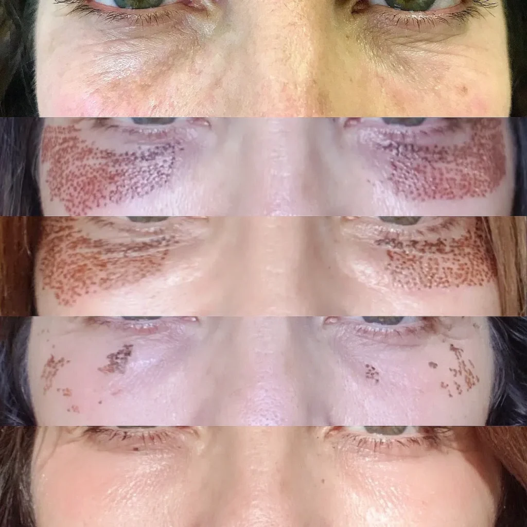 plasma skin tightening in melbourne client results