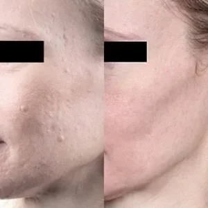 skin needling client results melbourne