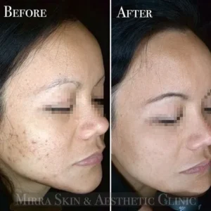 skin needling skin treatment client results