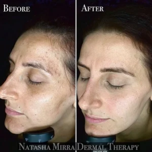 skin needling skin treatment client results